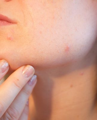 Nonacne – Lek na Trądzik – Opinie, recenzje, oferty – Gdzie kupić ? Nonacne
