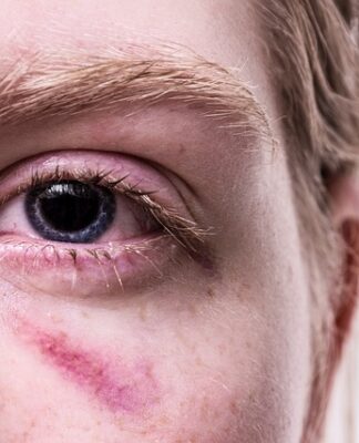 Co zrobić z siniakami pole dance? Co zrobić z siniakami pole dance?