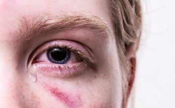 Co zrobić z siniakami pole dance?