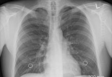 Jak wyglądają płuca po roku nie palenia? Jak wyglądają płuca po roku nie palenia?