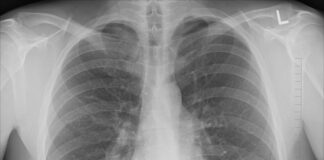Jak wyglądają płuca po roku nie palenia?